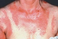 Tratamiento problemas de dermatitis fotosensible en toluca