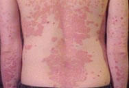 Tratamiento problemas de dermatitis fotosensible en metepec