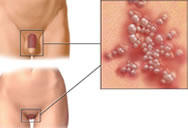 Tratamiento para enfermedades de la piel en los genitales en metepec